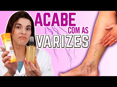 Vídeo: Veias de aranha: maneiras seguras de se livrar delas + dicas de prevenção