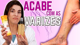 ACABE Com as VARIZES usando essa Receita e Dicas