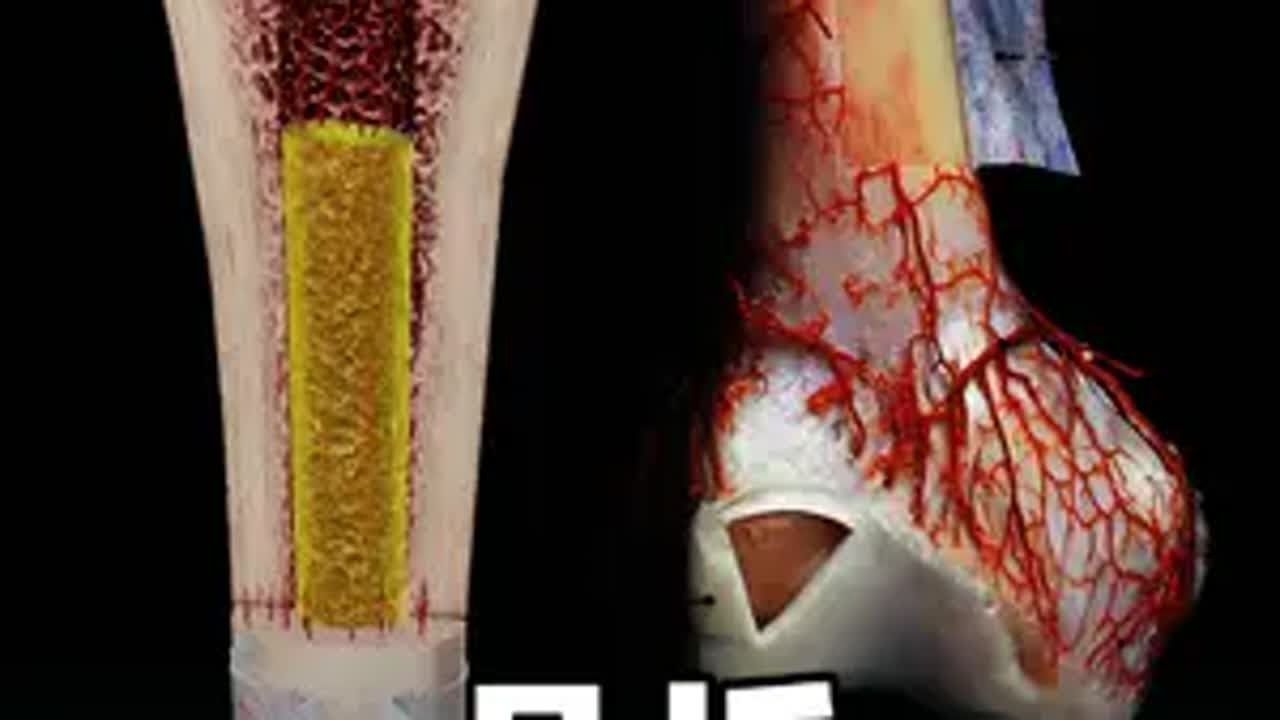 骨折，断端是怎么愈合在一起的？ 解剖学 医学生 骨折 抖出健康知识宝藏  医学科普