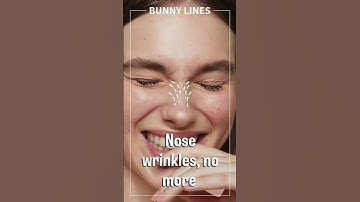 Botox treatment by Dr Sonia Mangal #wrinkles #botoxresults #lookyounger #skincare #wrinklereduction