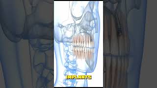 Dental implants improves talking?