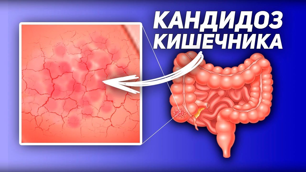 Как ВЫЛЕЧИТЬ Кандидоз Кишечника / У Кандида Альбиканс Нет Шансов, Если ...