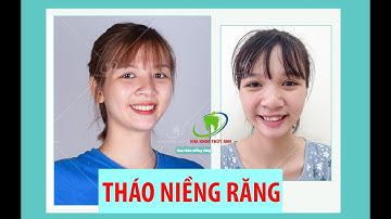 Rạng rỡ sau 19 năm không dám cười...{Tháo Niềng Răng chữa răng hô, lệch lạc}