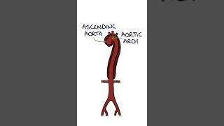 Aortic Dissection #medicine #vascularsurgery