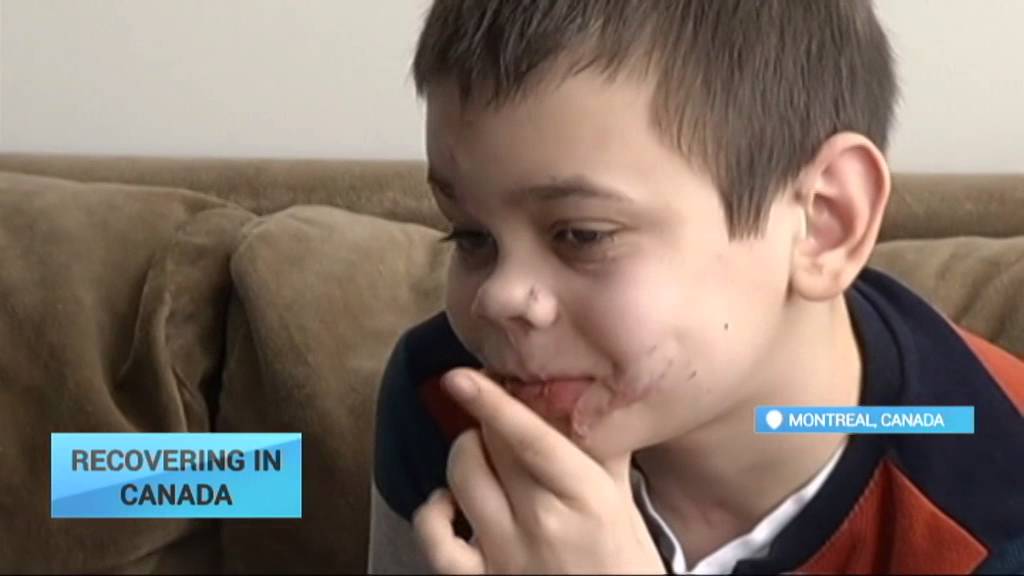 Ukrainian Boy Recovering In Canada 11 year old Mykola Lost Both Legs Ukrainian Boy Recovering In Canada 11 year old Mykola Lost Both Legs