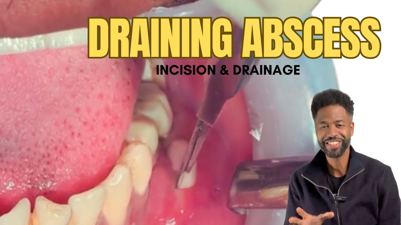 Draining a abscess with Ken the Dentist YouTube