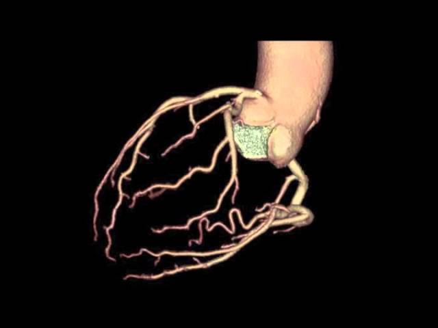冠動脈CT - YouTube