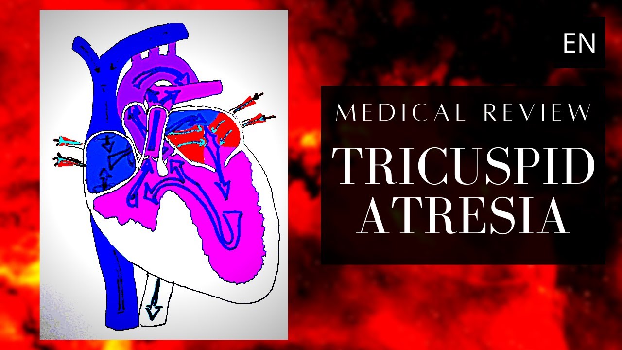 Understanding Tricuspid Atresia
