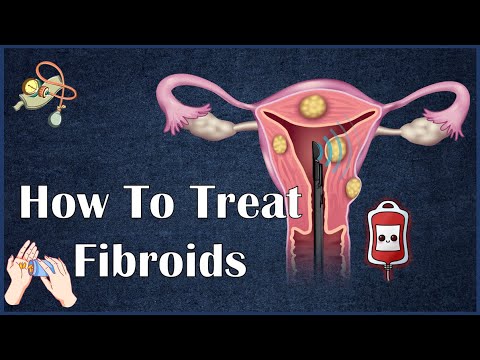 Video: Jinsi ya kukomesha fibromatosis?