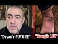 Engin talks about devons future  georgis leg amputation