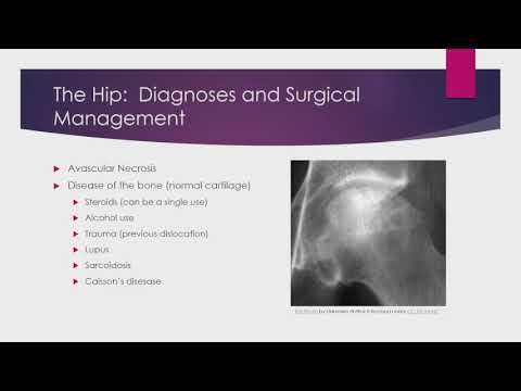Management of Degenerative Joint Disease of the Hip/Hip Replacement: Paul Lombardi, MD