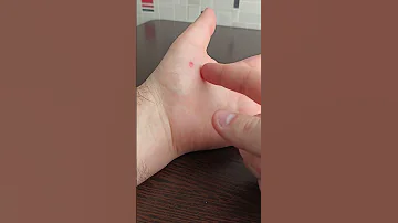 Как избавиться от укуса целующего жука. Последствия укуса