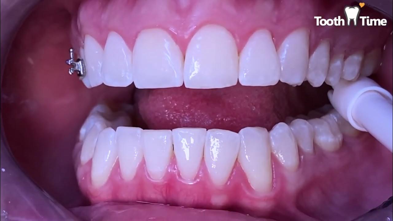 Braces Again? Why would I need braces a second time? Treating