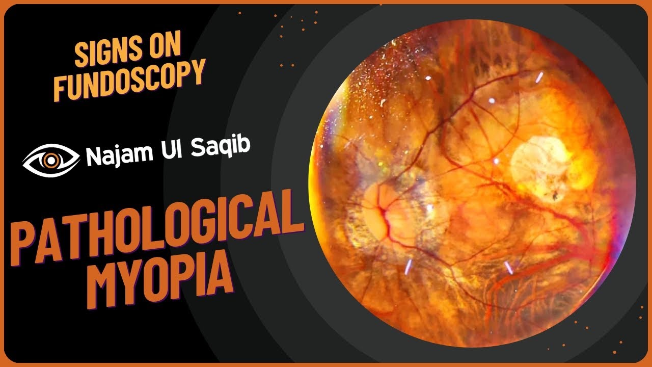 Retinal Signs Of Pathological Myopia As Seen On Indirect Ophthalmoscopy ...