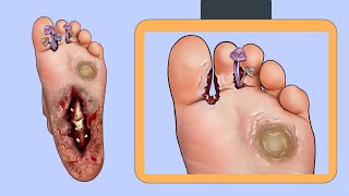 ASMR Athlete's Foot And Maggot Removal | Severely Injured Animation