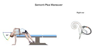 Semont-Plus Maneuver for Right Posterior Canal Benign Paroxysmal Positional Vertigo