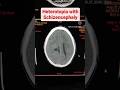 Heterotopia with Schizencephaly CT head #viral #youtubeshorts #shorts