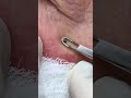 Blackheads so prime they practically pop themselves #DrPimplePopper #Satisfying #Extraction