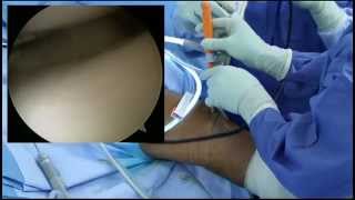 Meniscal Repair using Smith & Nephew FAST-FIX 360