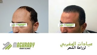 عيادات المغربي لزراعة الشعر في مصر - زراعة 2030 جرافت بطريقة الاقتطاف FUE