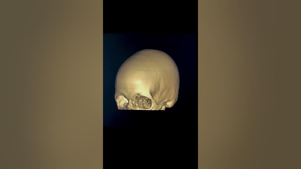 Occipital bone fracture 3D Trauma head injury CT scan Radiology ctscan radiology shorts