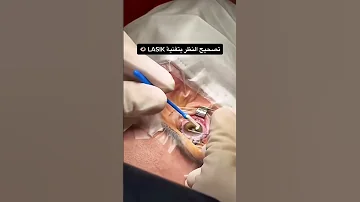 تقنية الليزك لتصحيح النظر من أكثر العمليات انتشارا 