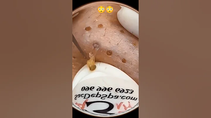 most satisfying pimple popping technique revealed😳 #shorts #pimplesremoval