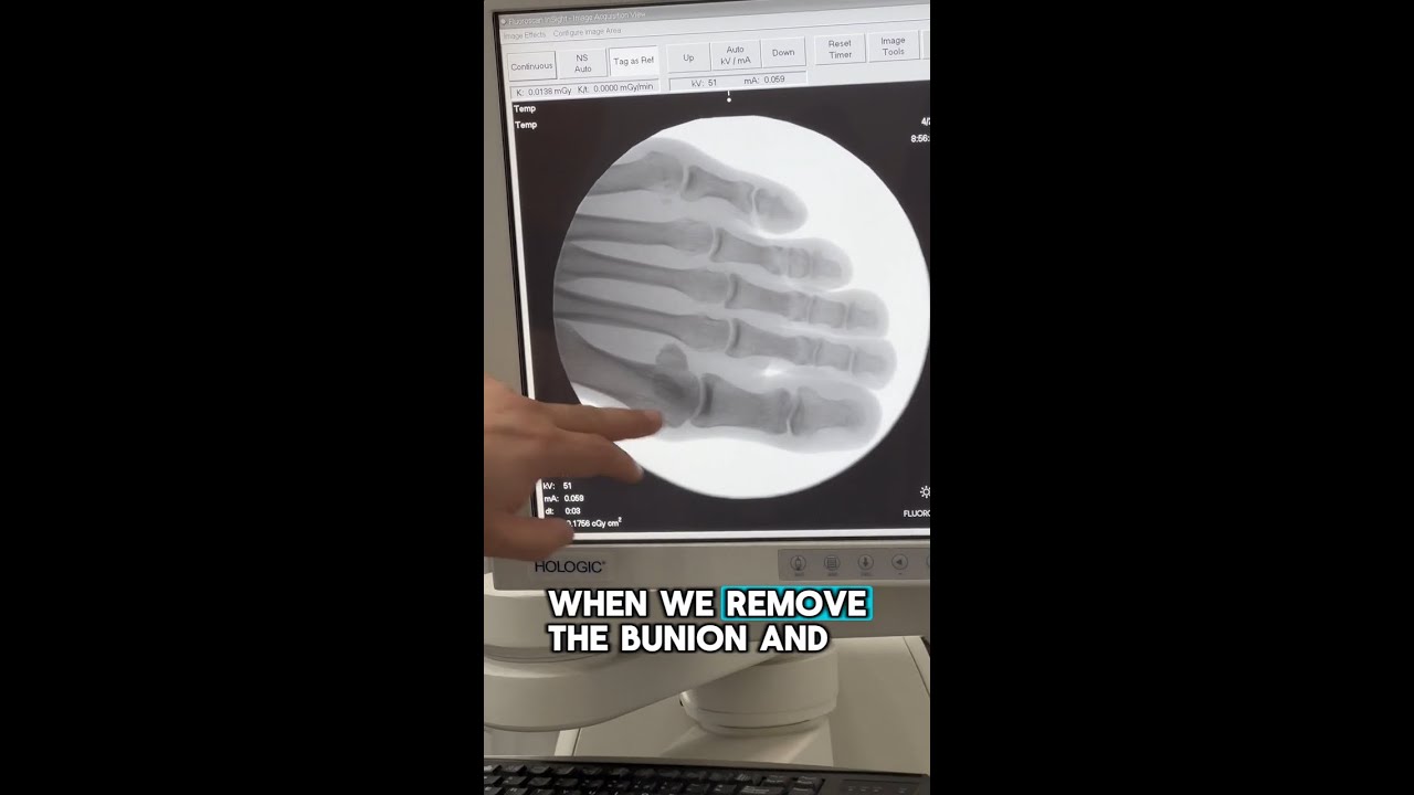 Let's fix a Tailor's Bunion!