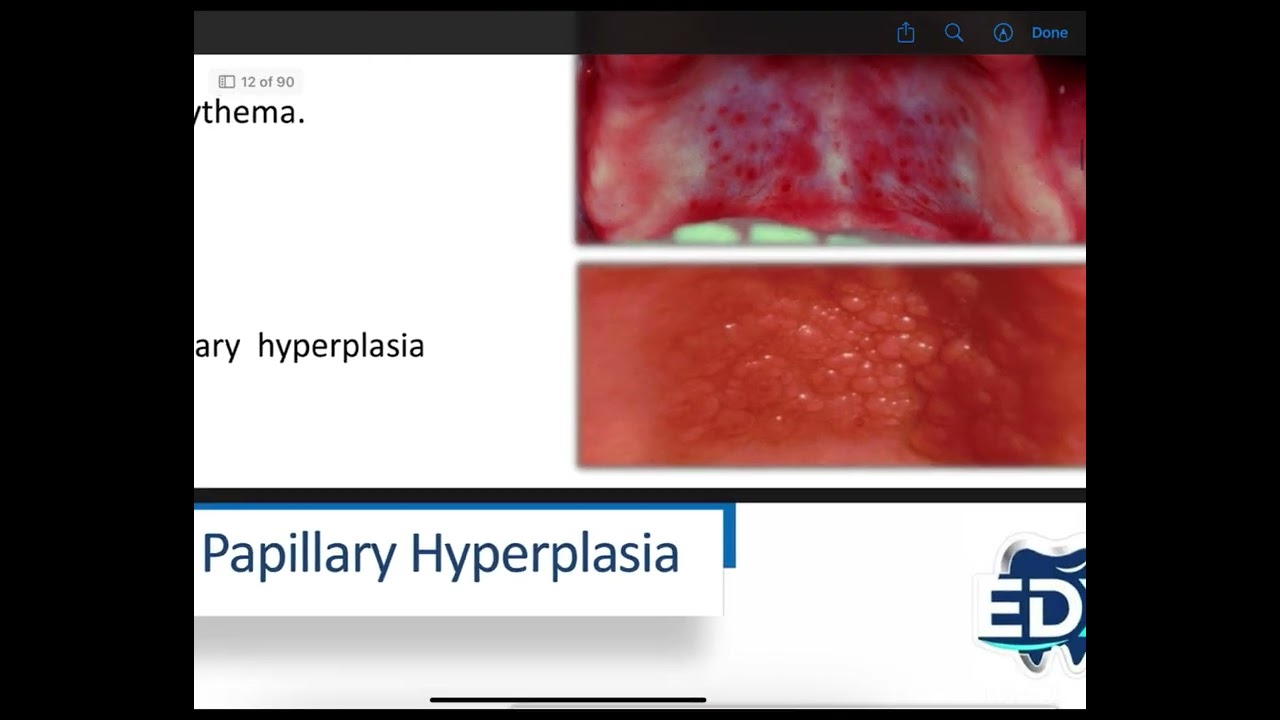 شرح  complications in complete denture wearers part 2