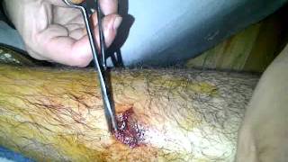 Crazy Boy Bloody Arm
