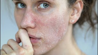 DRY SKIN: 3 Best ingredients For Dry Cracked Skin