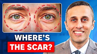 Eyelid Surgery Scars Will You Get One?