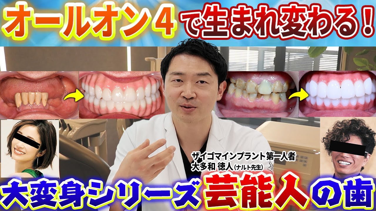オールオン4で芸能人みたいな歯になれた症例全部見せます！ナルト先生の美的センスにも大注目！