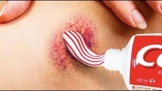 ¿Cómo quitar moretones con pasta dental?
