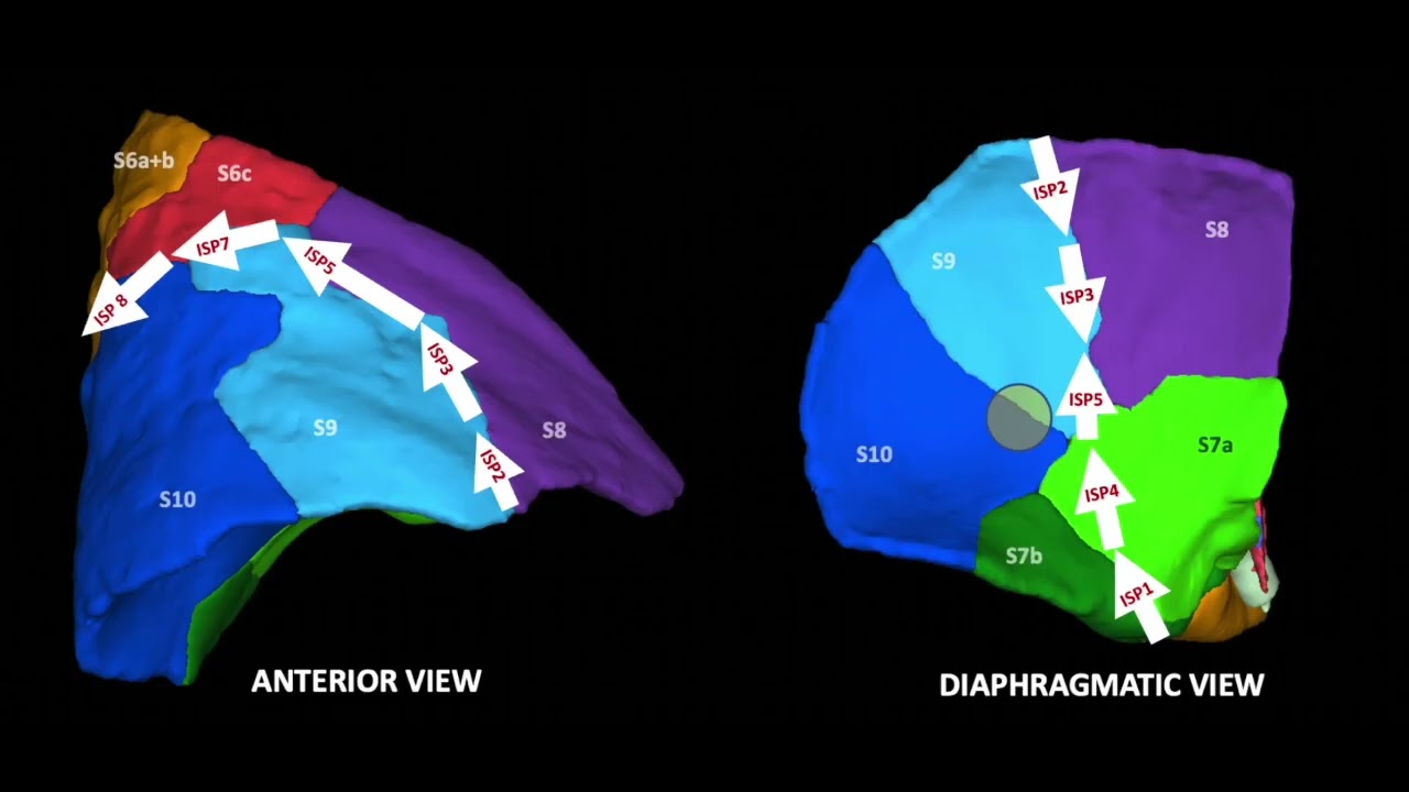 Asvide: This video demonstrates, step by step, a right thoracoscopic S9+10 segmentectomy through...