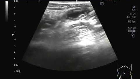 Ultrasound Video showing Faecolith in the Appendix