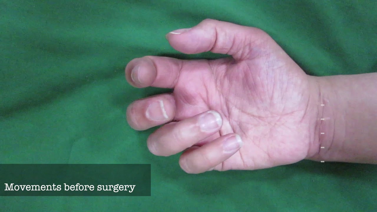 Nerve and tendon reconstruction