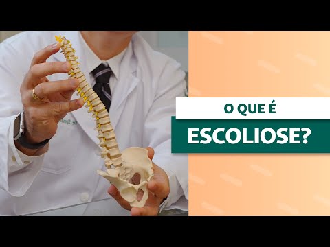 Vídeo: Escoliose Grau 4 - Características, Sintomas E Tratamento