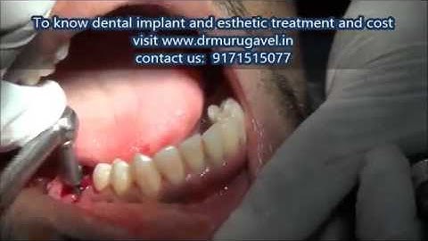Immediate extraction of decayed first molar and immediate 2 BCS implant insertion video