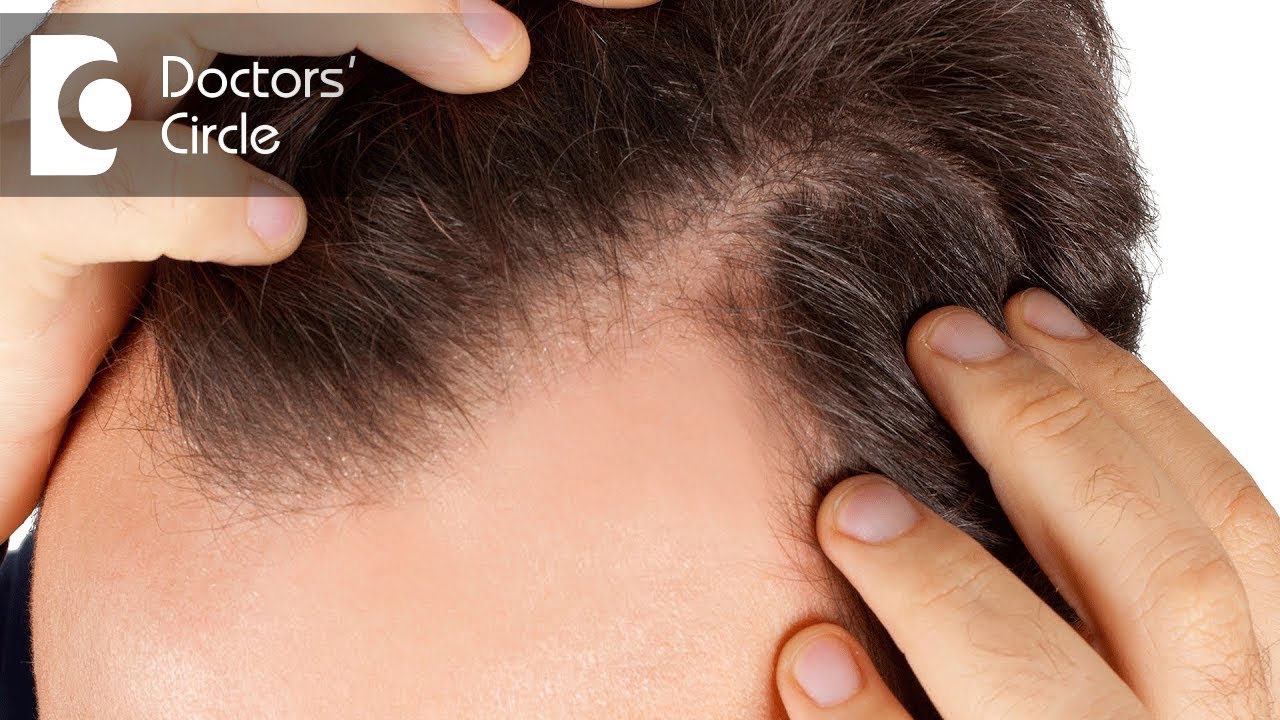 Can biotin supplements lead to hairfall & its role in hair regrowth? - Dr. Harish Prasad B R