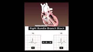 Satu Menit Membaca Ekg Rbbb