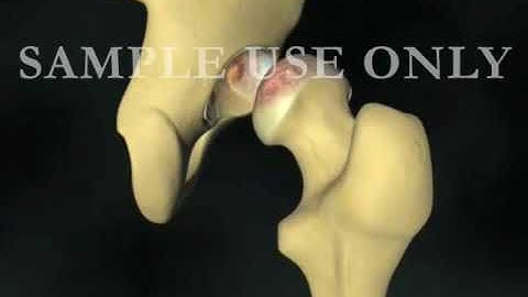 Total hip replacement video | Best orthopedic surgeon in Ahmedabad | Dr. Saurin Shah