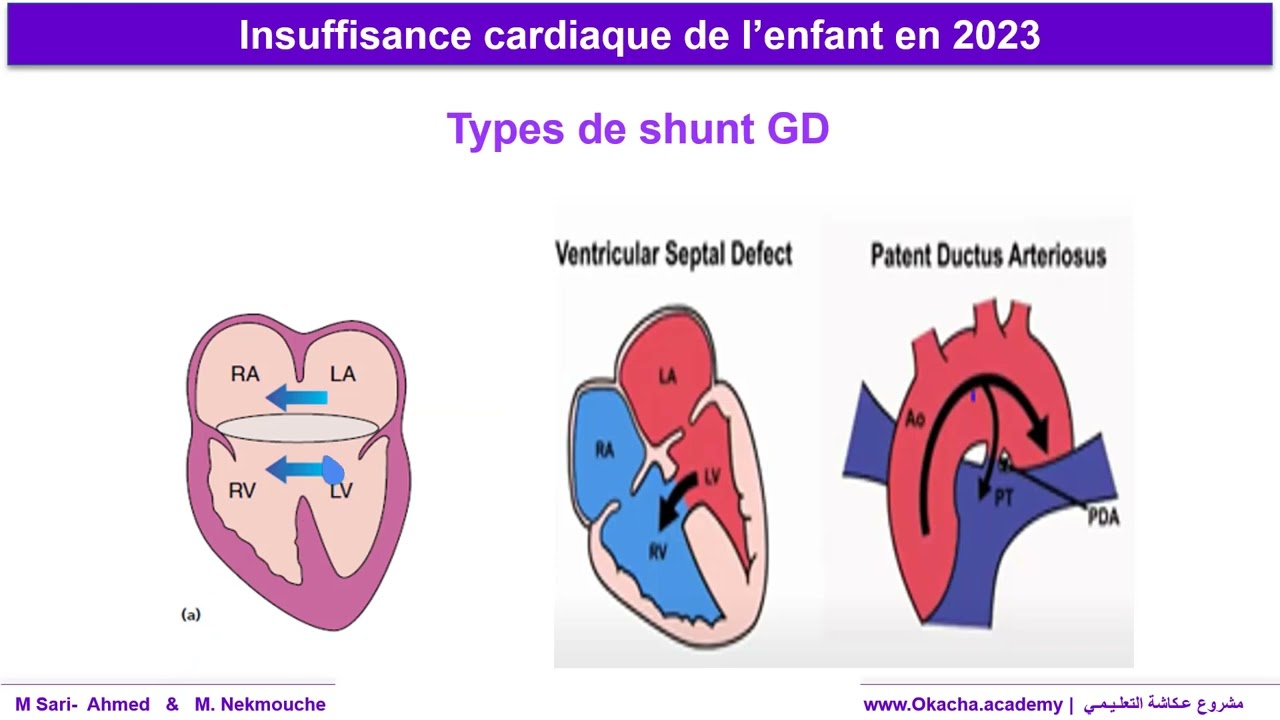 Insuffisance cardiaque de l'enfant en 2023 - Pr sarri