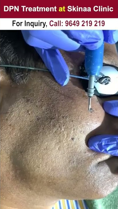 DPN Treatment at Skinaa Clinic #DPN #dpntreatment #reels #instareels #skinaa_clinic #skinaaclinic