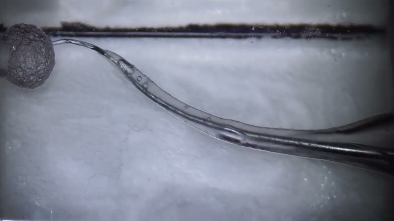 New technique to remove a non-visible broken file in a double curvature canals. Dr Terauchi