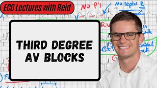 Third Degree AV Blocks | Day 7 ECG Challenge