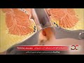 فیلم عمل جراحی شقاق مقعدی فیلم عمل جراحی شقاق مقعدی