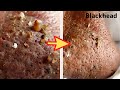 【角栓除去】極太!大量のニキビを芯出しするのって気持ちいい/Blackhead Removal Show