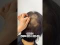 원형탈모, 방치하면 더 퍼집니다… 지금 관리하세요