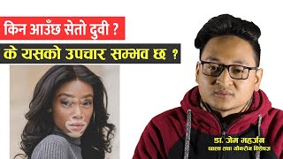 के  सेतो दुबीको उपचार छ ?  कसरी हटाउने ? | (Vitiligo Setodubi) | Nepali Health Tips | Doctor Saathi